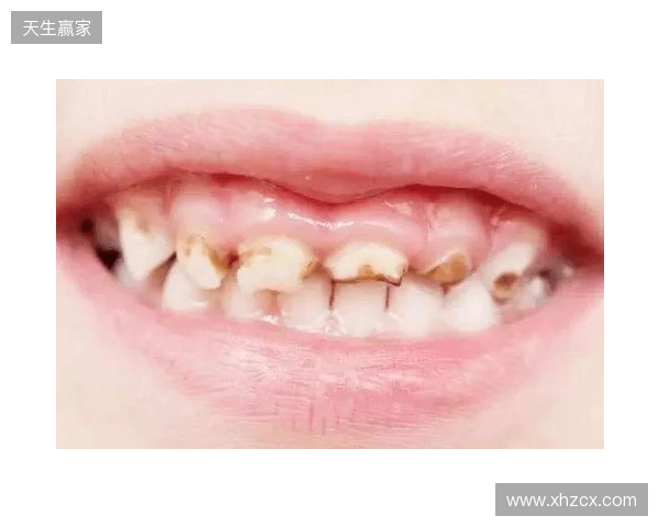 韦林顿确诊上唇部贯通伤；11、21牙半脱位；上颌前牙区牙槽骨骨折